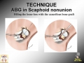 Scaphoid Nonunion