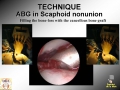 Scaphoid Nonunion