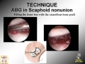 Scaphoid Nonunion