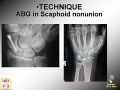 Scaphoid Nonunion