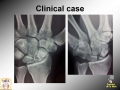 Scaphoid Nonunion