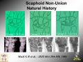 Scaphoid Nonunion