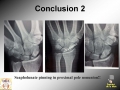 Scaphoid Nonunion