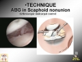 Scaphoid Nonunion