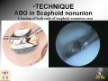Scaphoid Nonunion