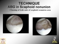 Scaphoid Nonunion