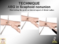 Scaphoid Nonunion