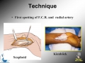 Scaphoid nonunion