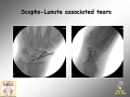 Scaphoid fracture