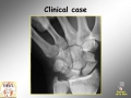 Scaphoid fracture