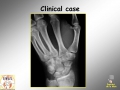 Scaphoid fracture