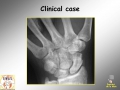 Scaphoid fracture