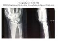 Young lady, breaking the scapholunate ligament Right wrist. 