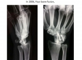 Young lady, breaking the scapholunate ligament Right wrist. 